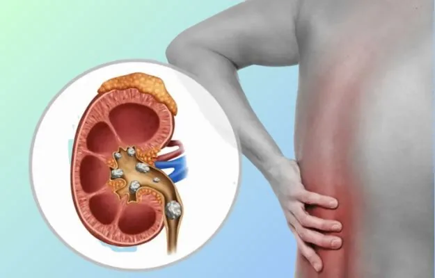 Medical management of kidney stones in Hyderabad by Dr. Ramesh Vasa